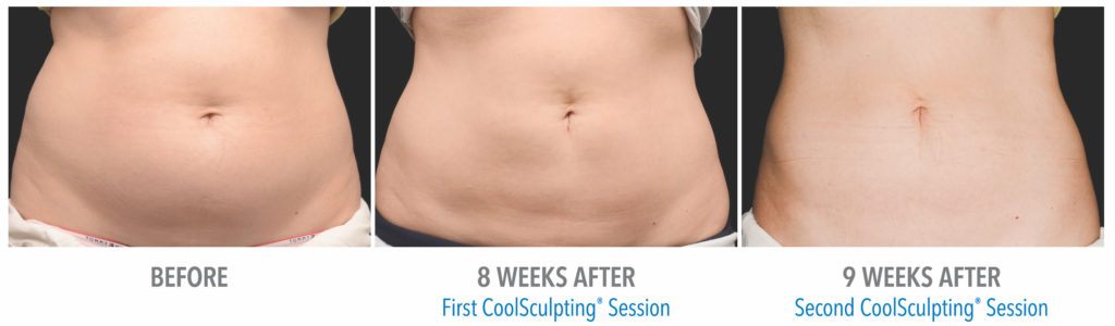 CoolSculpting before and after