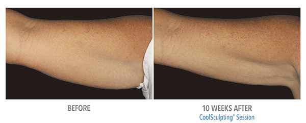 CoolSculpting Before & After