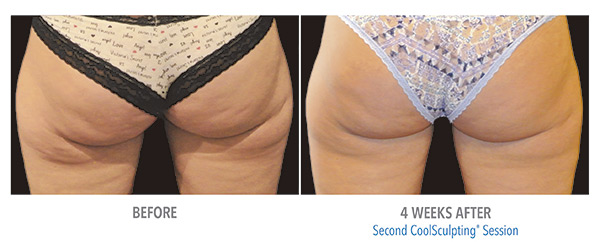 CoolSculpting Before & After