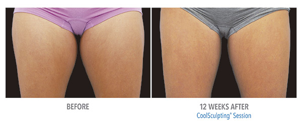 CoolSculpting Before & After