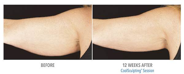 CoolSculpting Before & After