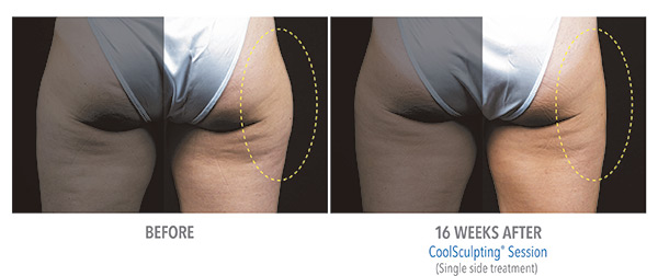 CoolSculpting Before & After